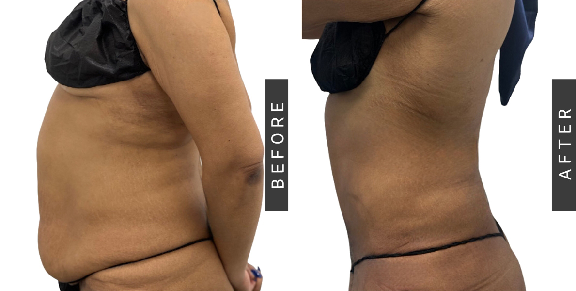 Lipo360 and Tummy Tuck Before & After Patient