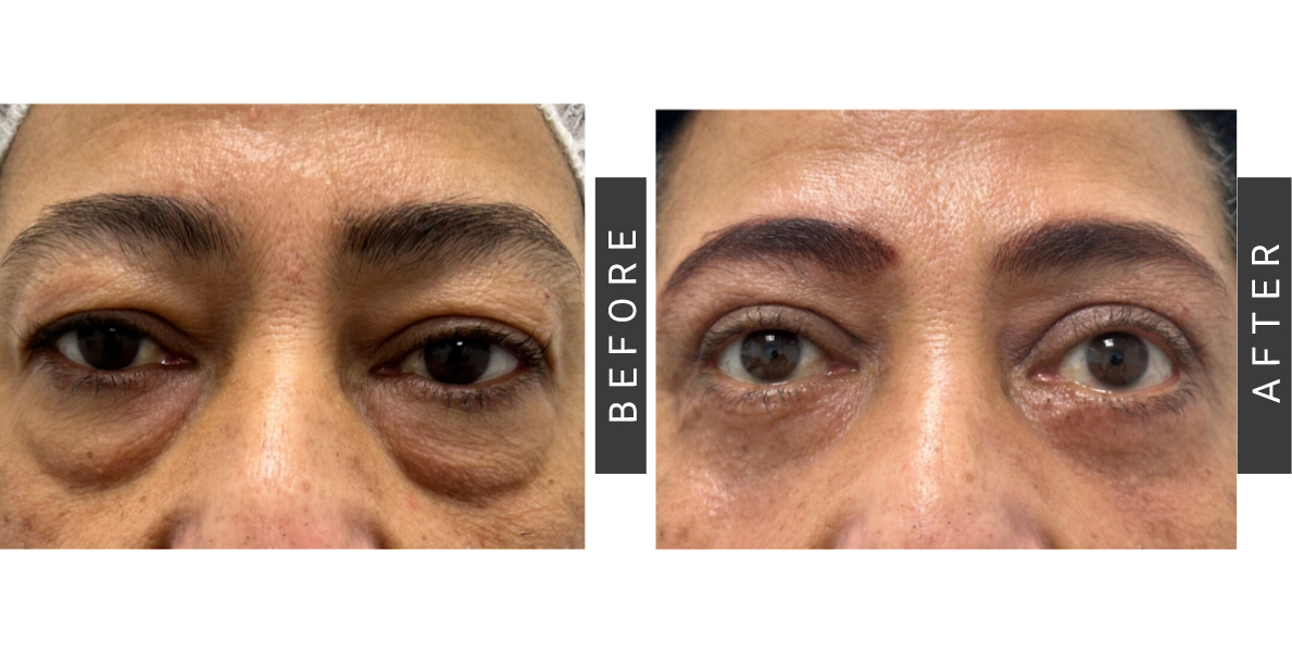 Upper Lower Blepharoplasty Before and After
