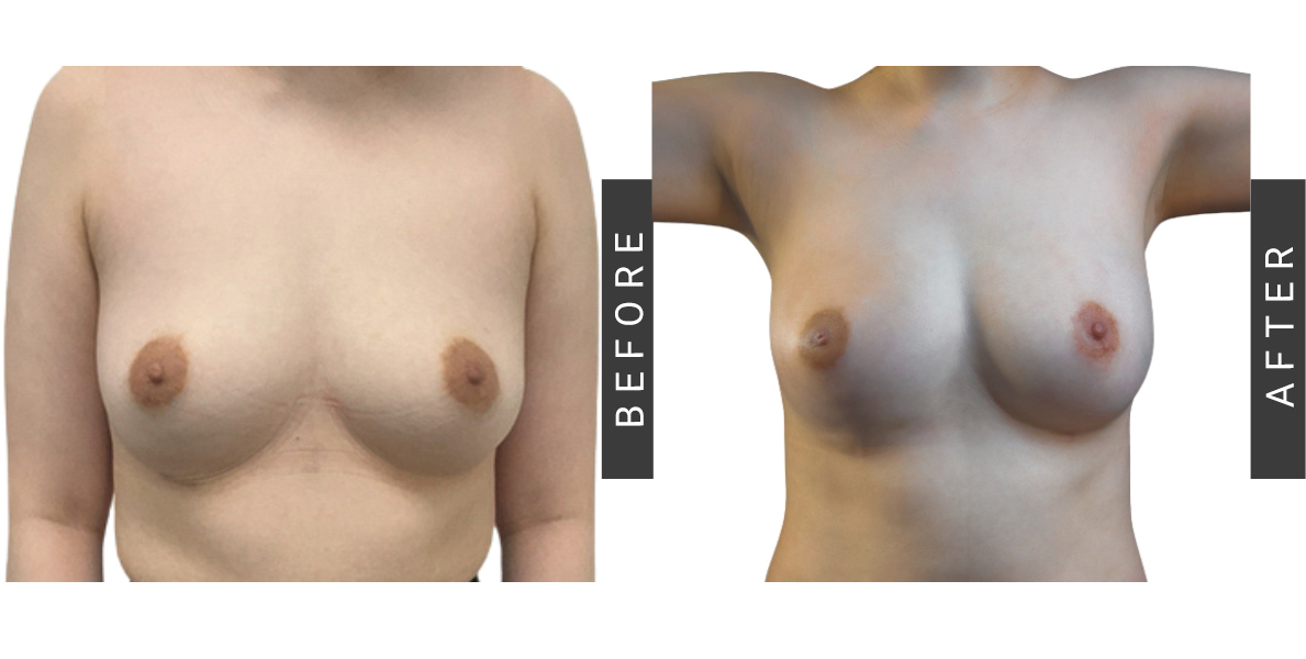 Breast Augmentation Before & After