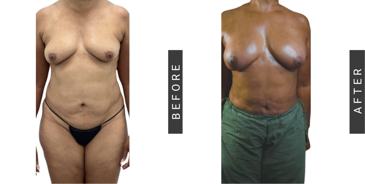 Breast Fat Grafting Before and After