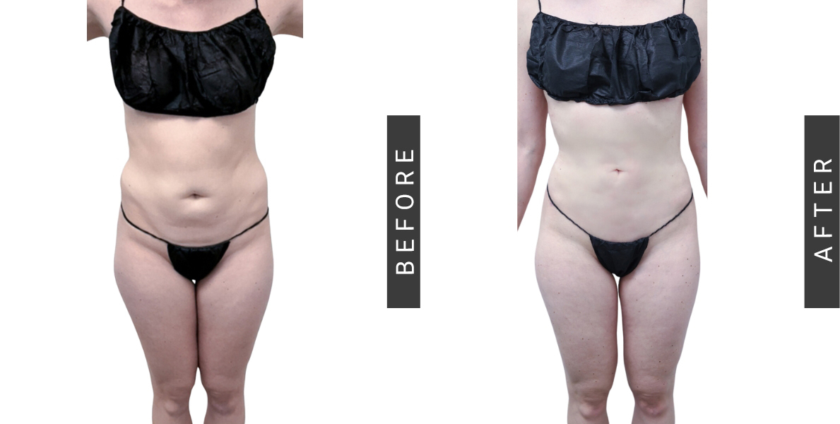 Lipo 360 Before and After