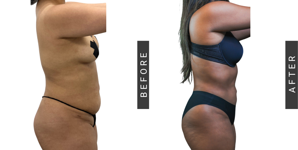 Lipo-360 Before and After