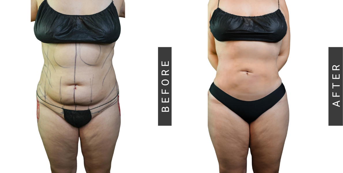 Lipo 360 and BBL Before and After