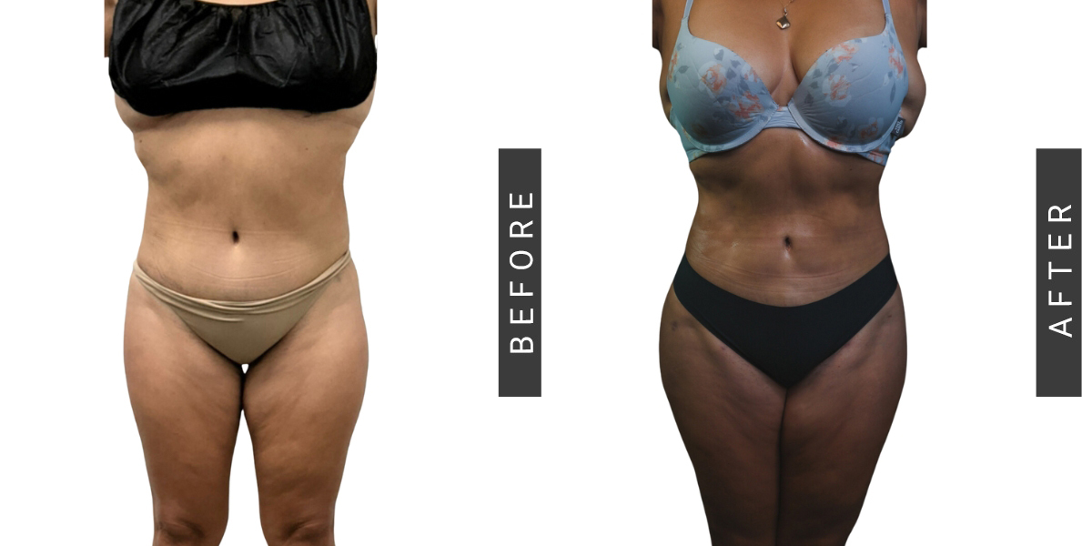 Lipo360 Before and After