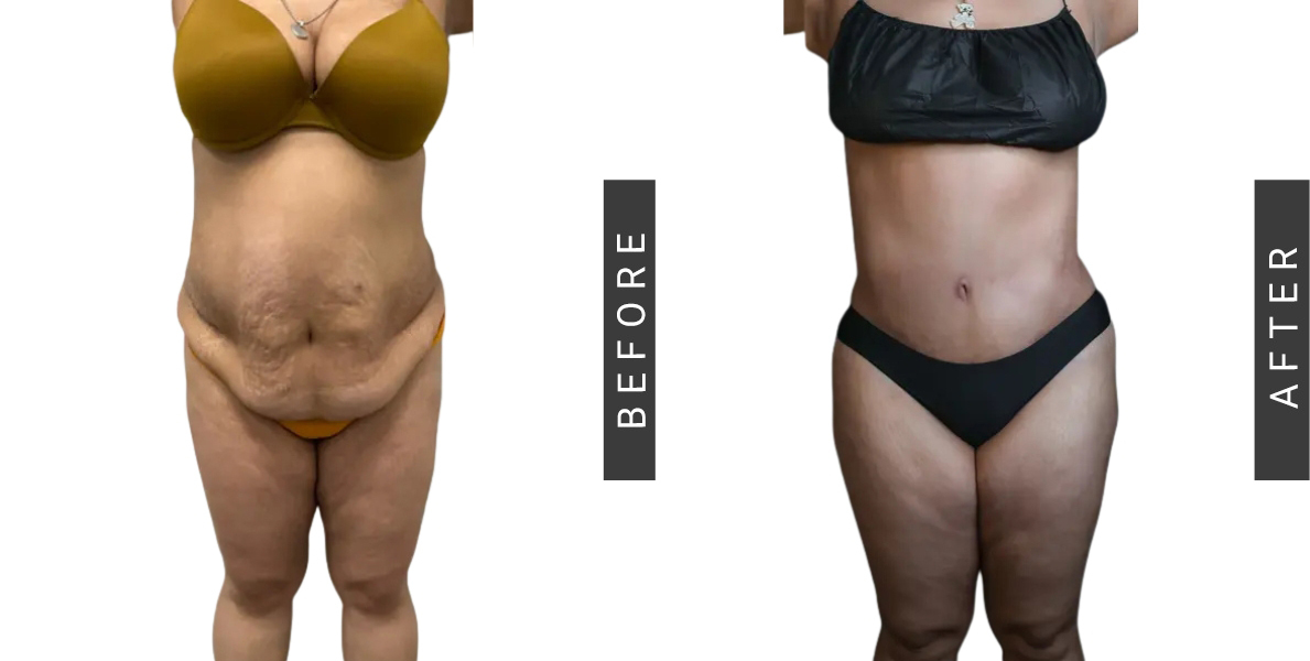 Tummy Tuck Before and After