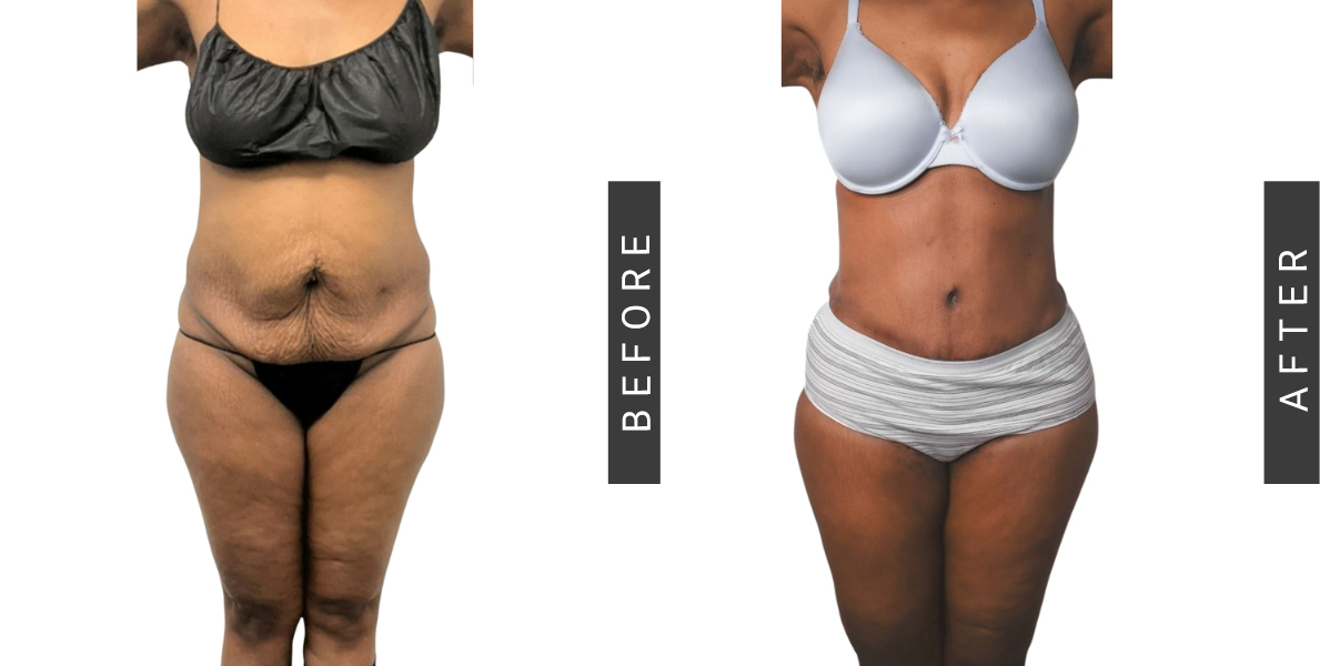 Tummy Tuck Before and After