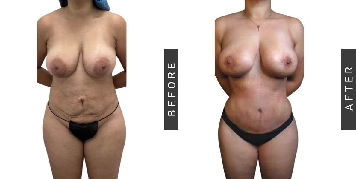 Tummy Tuck and Breast Lift Before and After