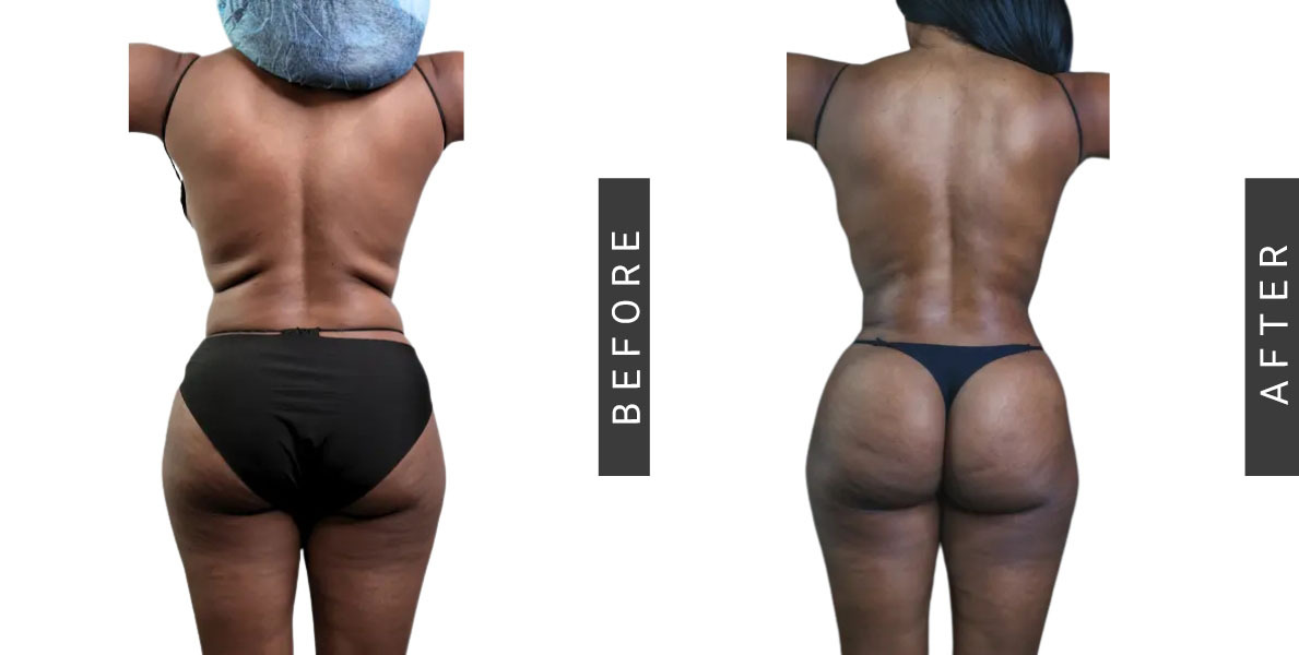 Lipo360 Before and after