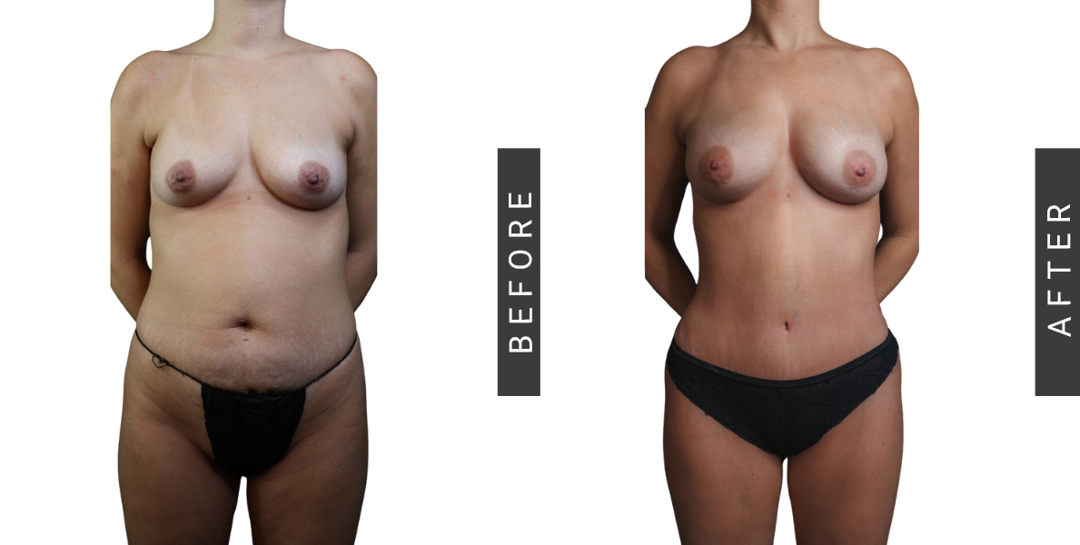 Fat Grafting to Breast and Tummy Tuck Before and After