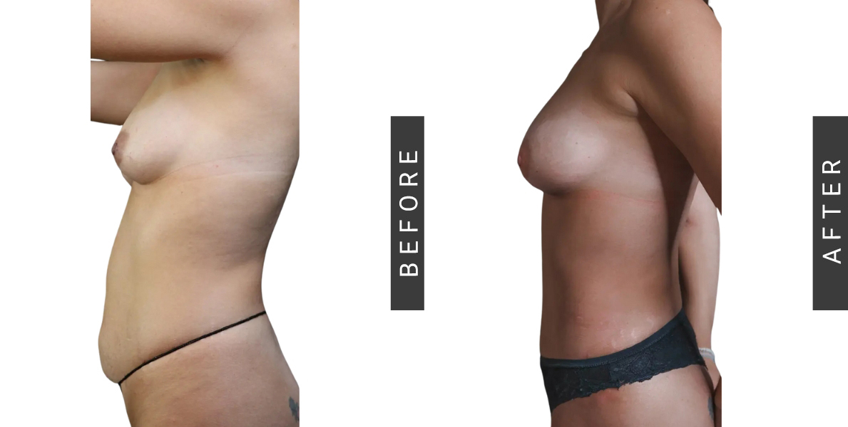 Fat Grafting to Breast and Tummy Tuck Before and After