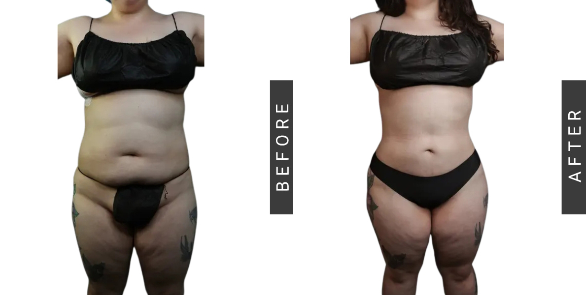 Tummy Tuck and BBL Before and After