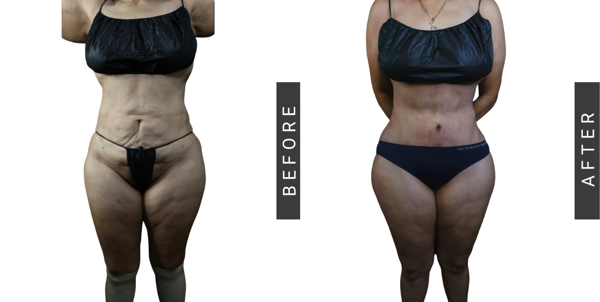 Tummy Tuck and BBL Before and After