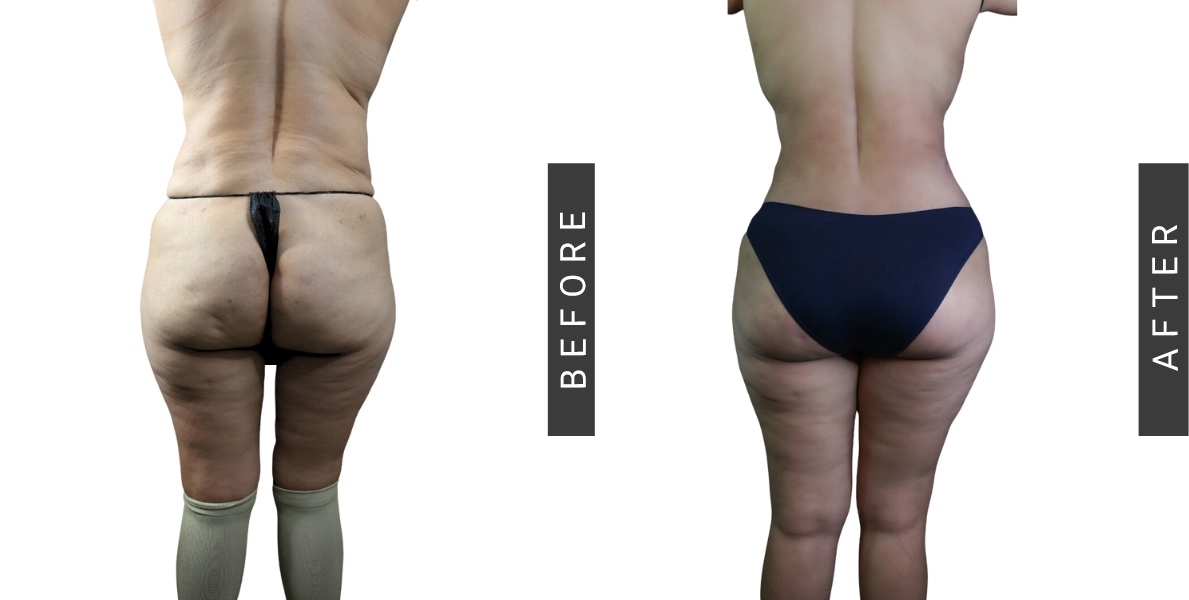 Tummy Tuck and BBL Before and After