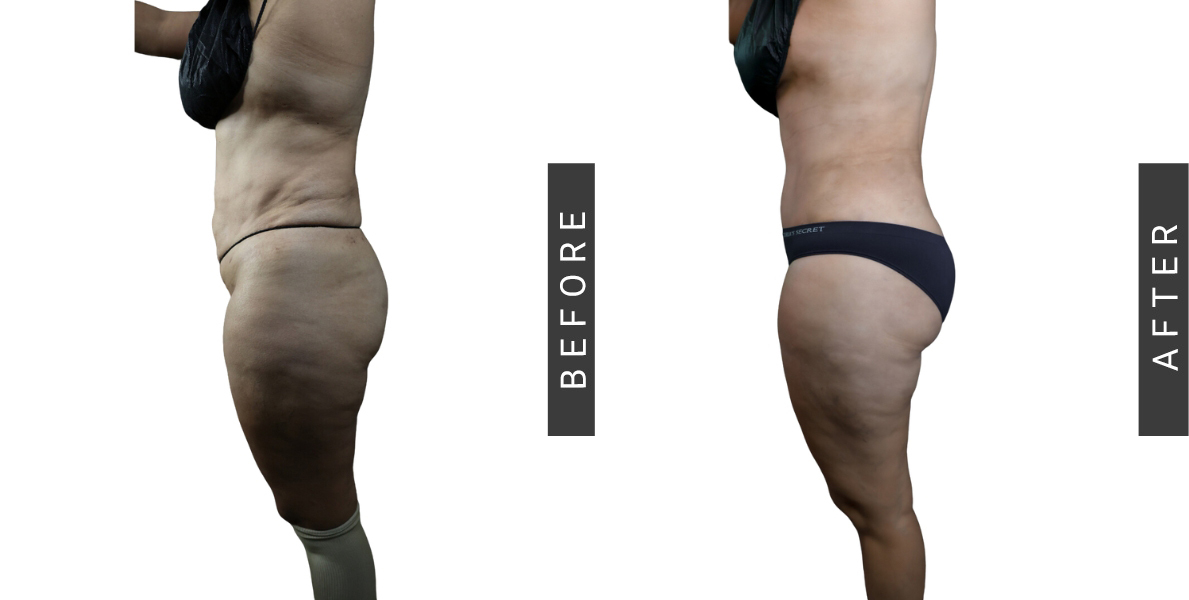 Tummy Tuck and BBL Before and After