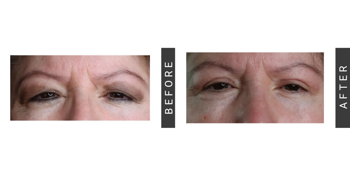 Blepharoplasty Before and After