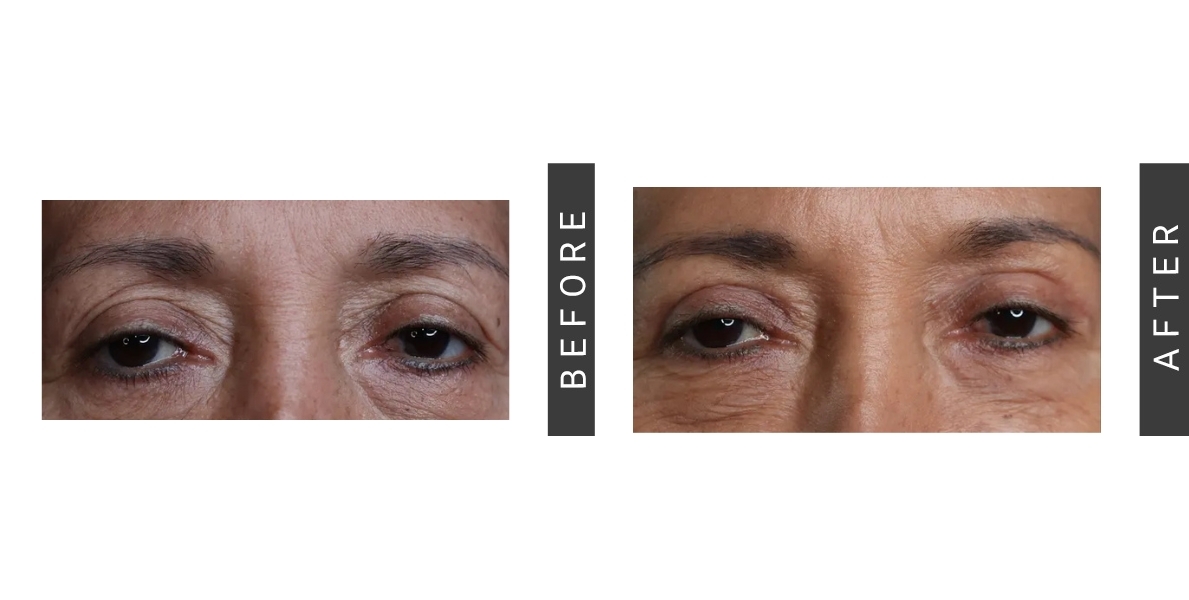 Blepharoplasty Before/After