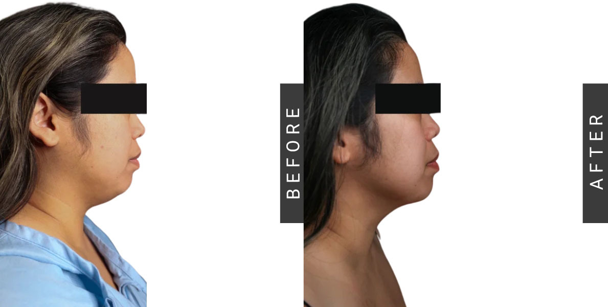 Chin Liposuction Bafore and After