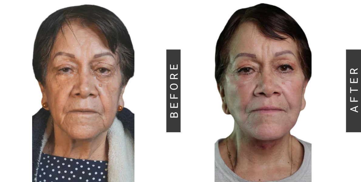 Facelift Before & After