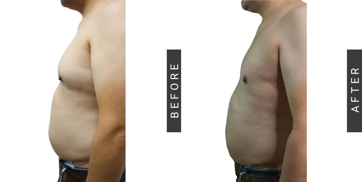 Gynecomastia Before & After
