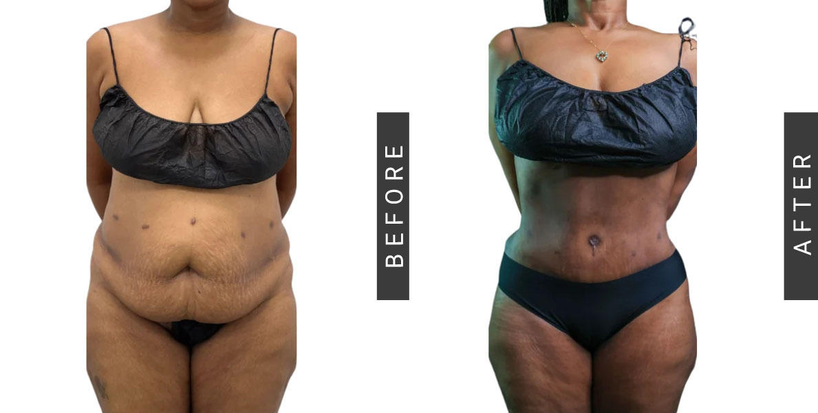 Tummy Tuck Before and After