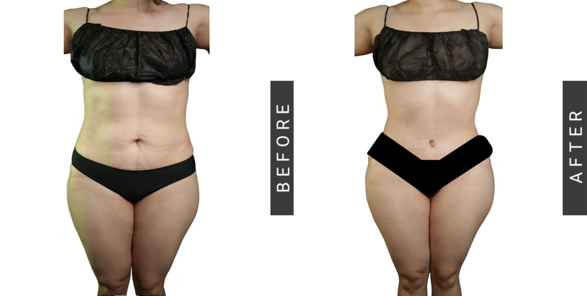 Tummy Tuck Before and After