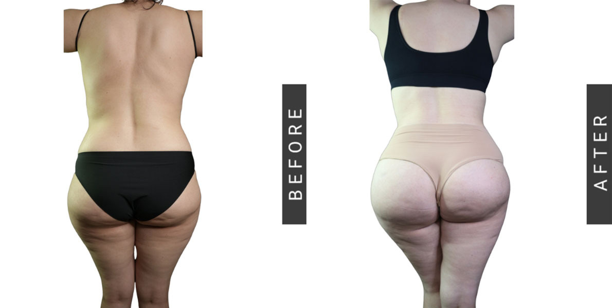 Brazilian Butt Lift Before and After