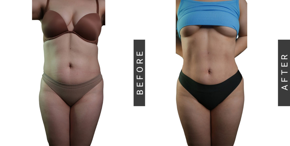 Lipo360 Before and after
