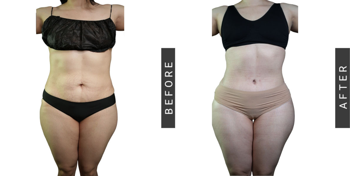 Tummy Tuck Before and After