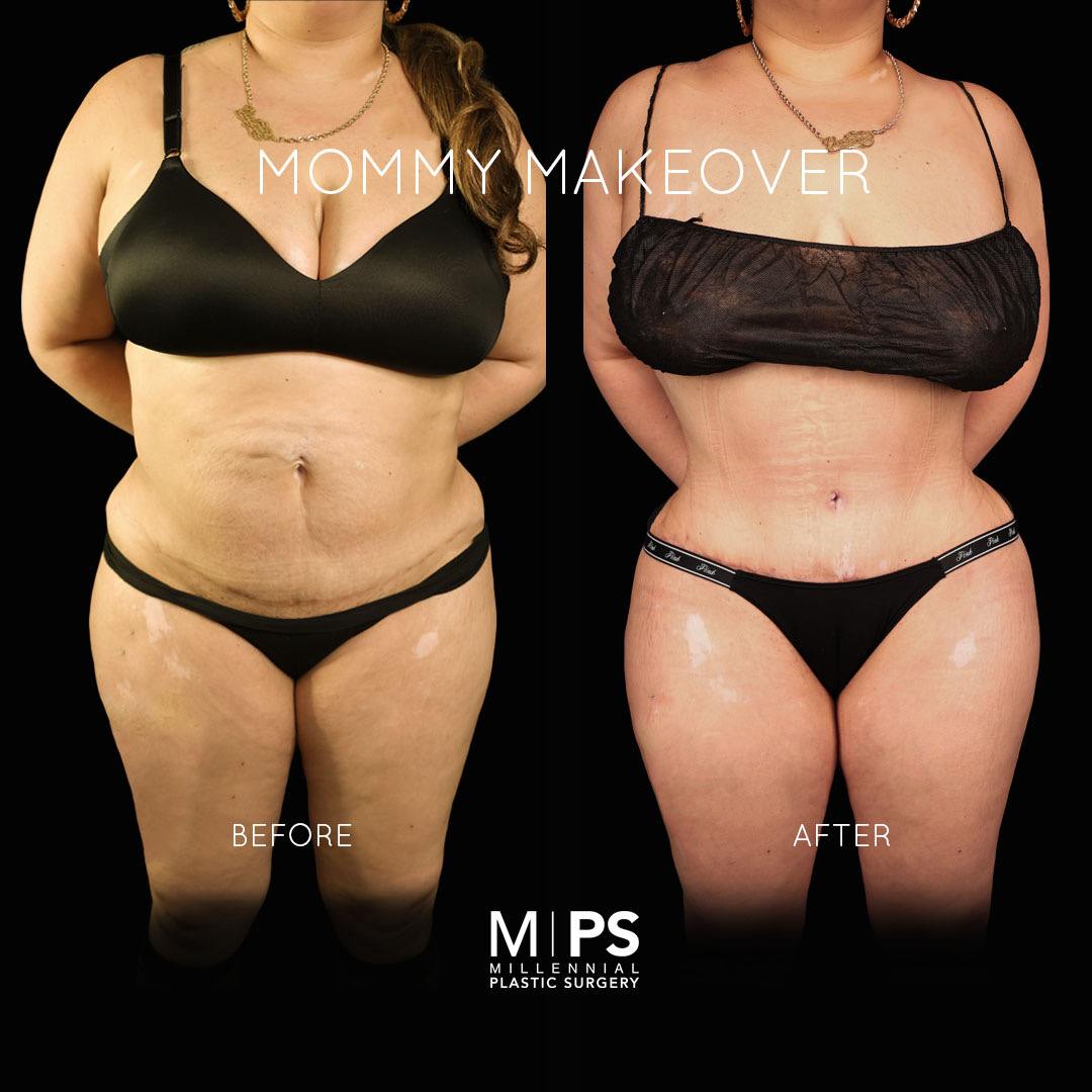 Mommy Makeover Before And After