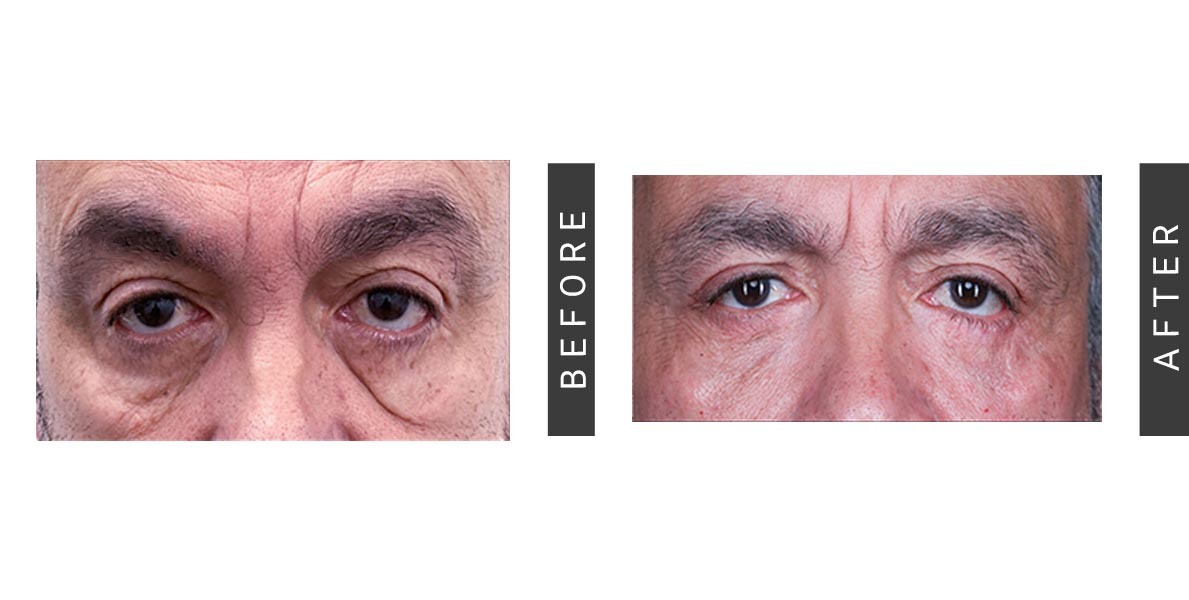 Blepharoplasty Before and After