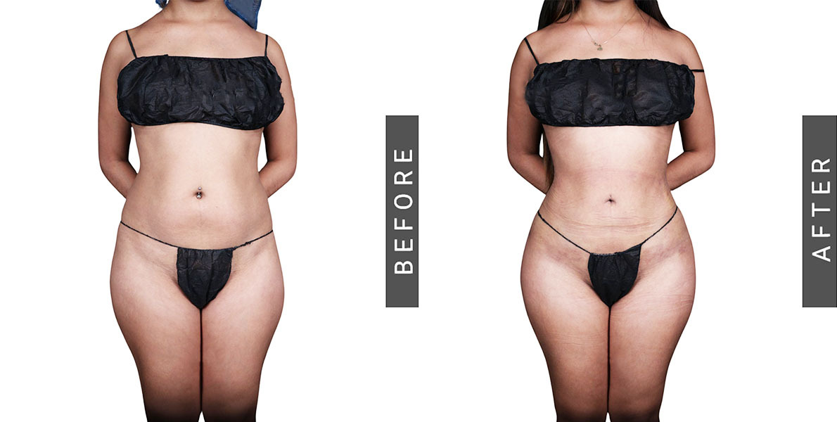 Lipo 360 and BBL Before and After