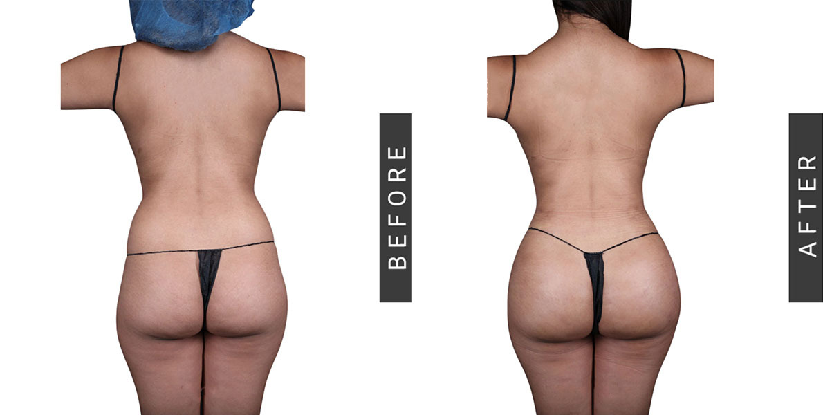 Lipo 360 and BBL Before and After