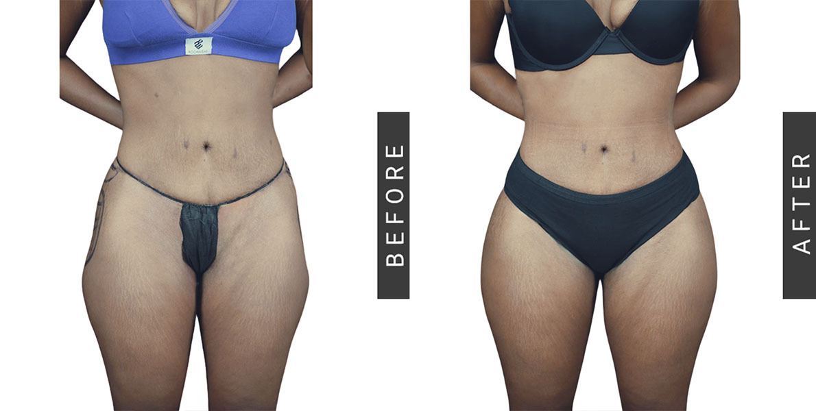 BBL Before and After