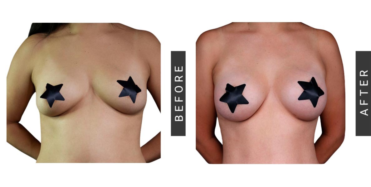 Breast Augmentation Before & After