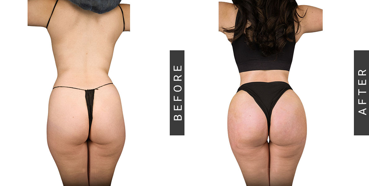 Lipo 360 and BBL Before and After