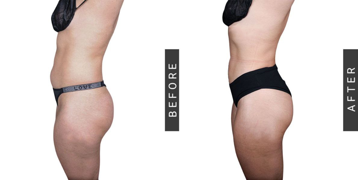 Liposuction Before and After