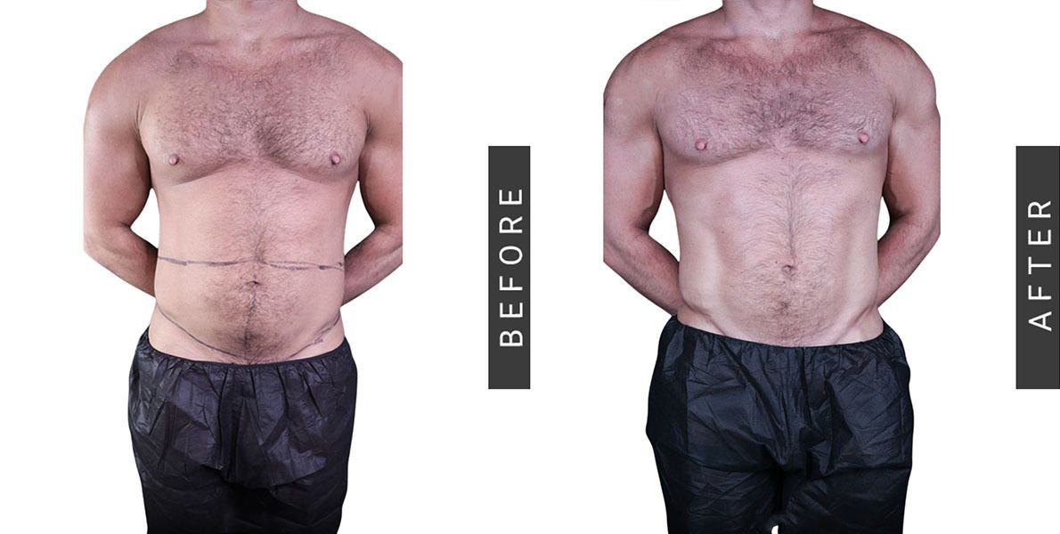 Male Body Sculpting Before and After