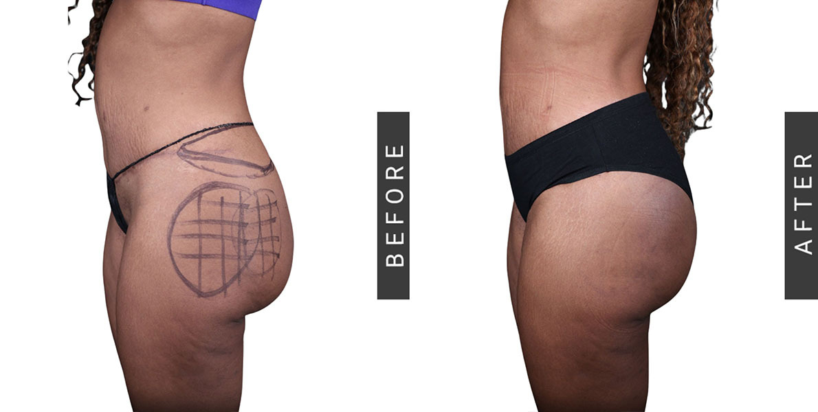 Alloclaeand BBL Before and After