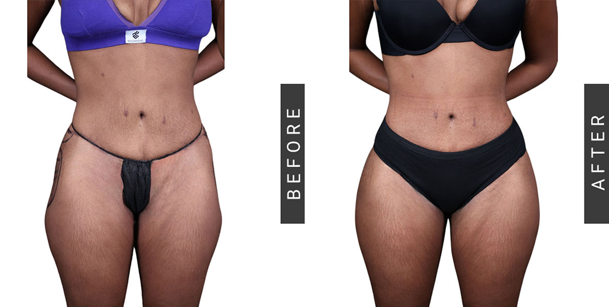 Alloclaeand BBL Before and After