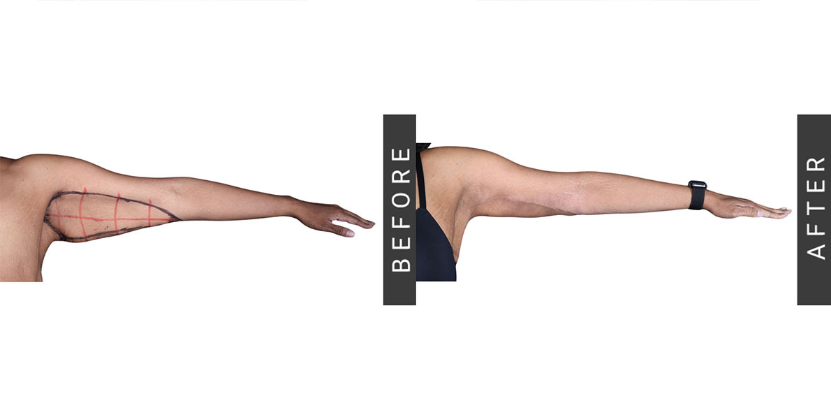 Brachioplasty Before and After