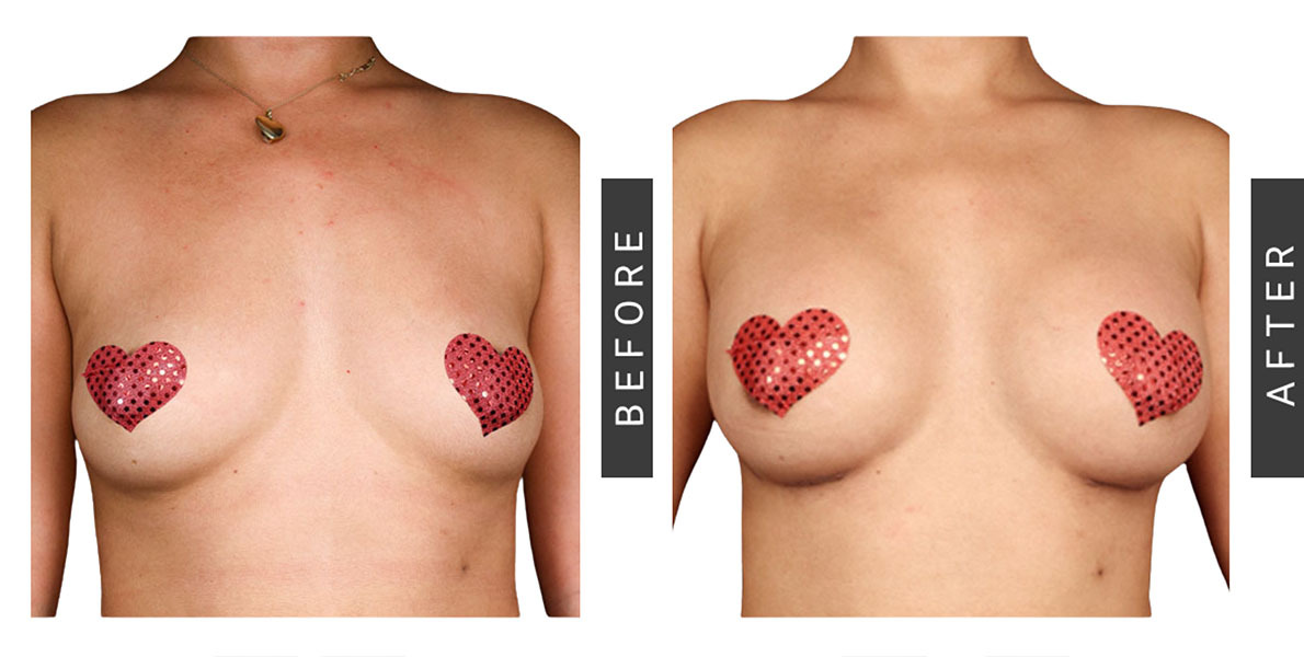Breast Augmentation Before & After