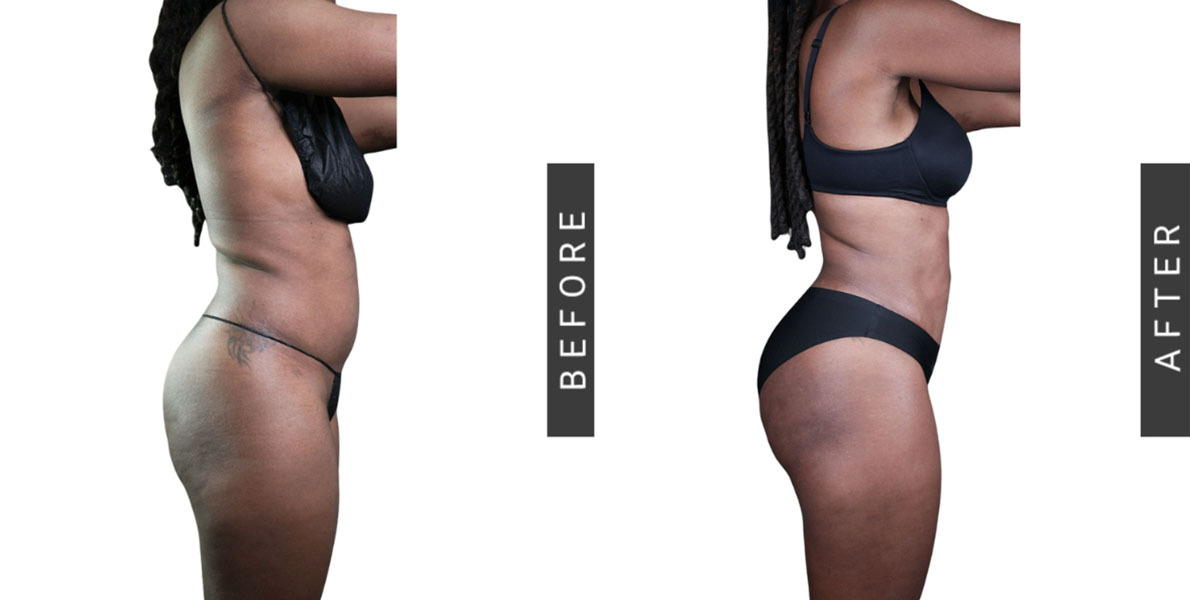 Lipo 360 and BBL Before and After
