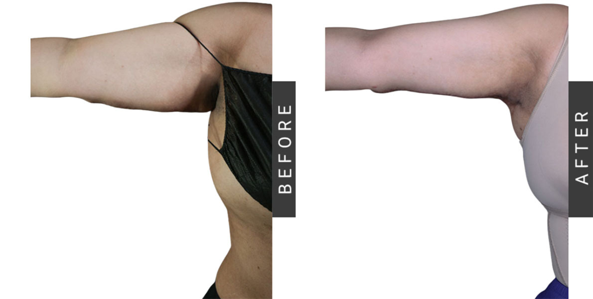 Arm Lipo Procedure Before-After