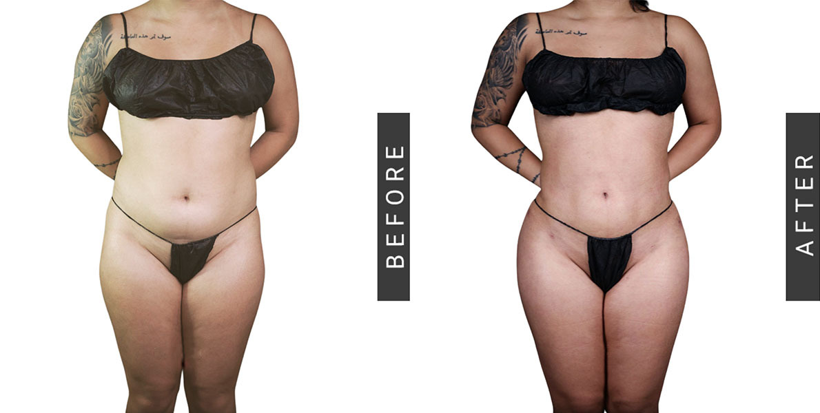 Lipo 360 and BBL Before and After