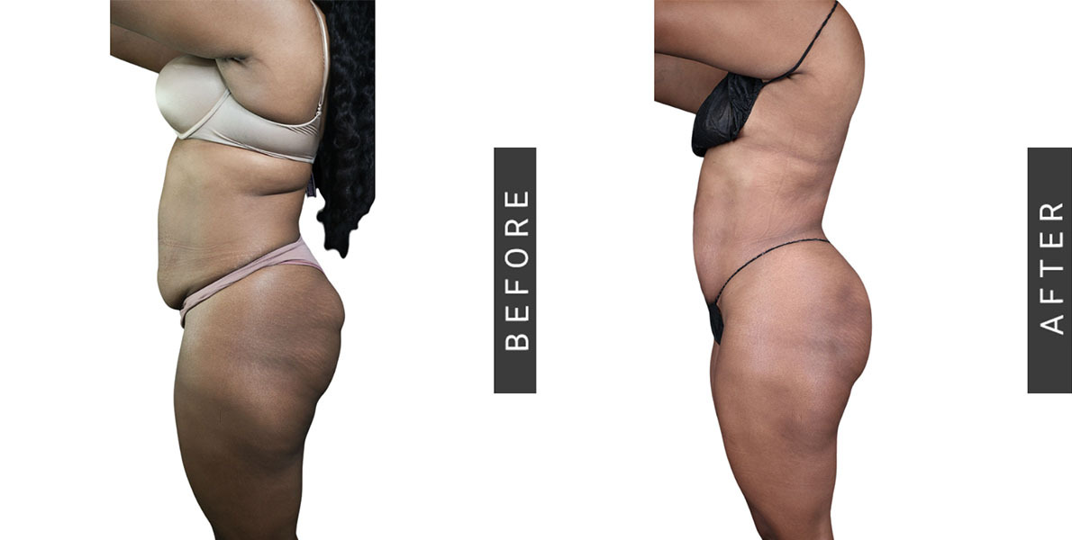 Lipo 360 and BBL Before and After