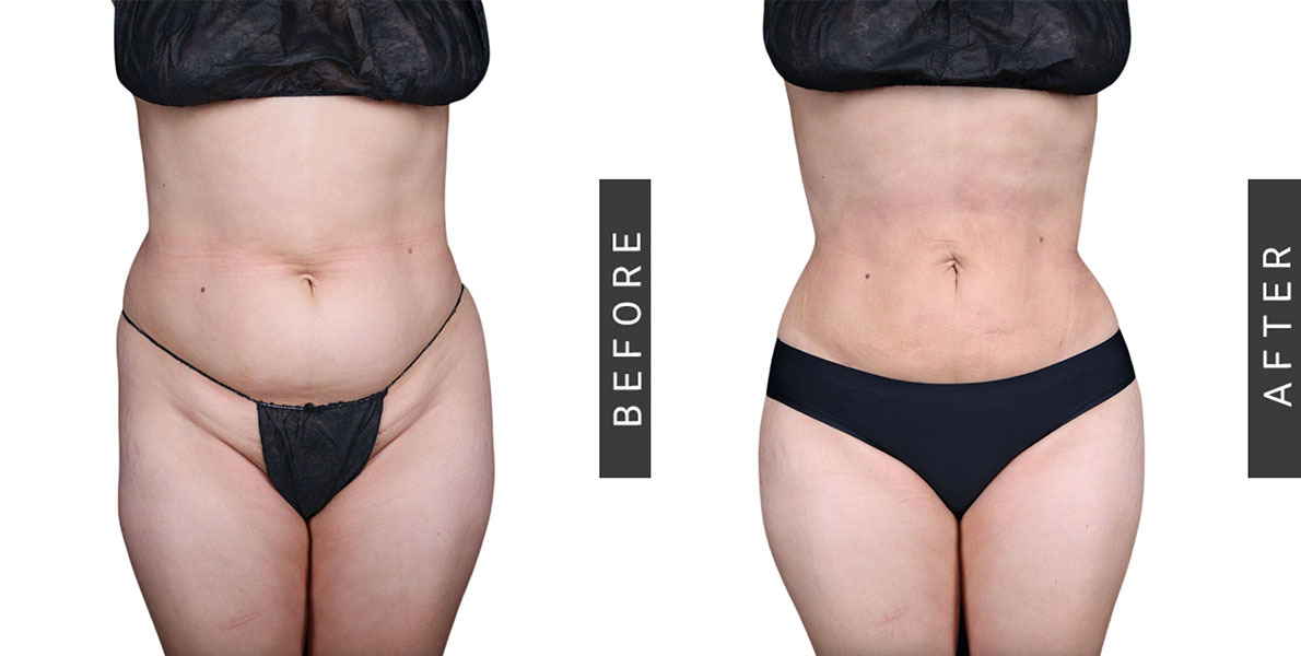 Lipo 360 and BBL Before and After