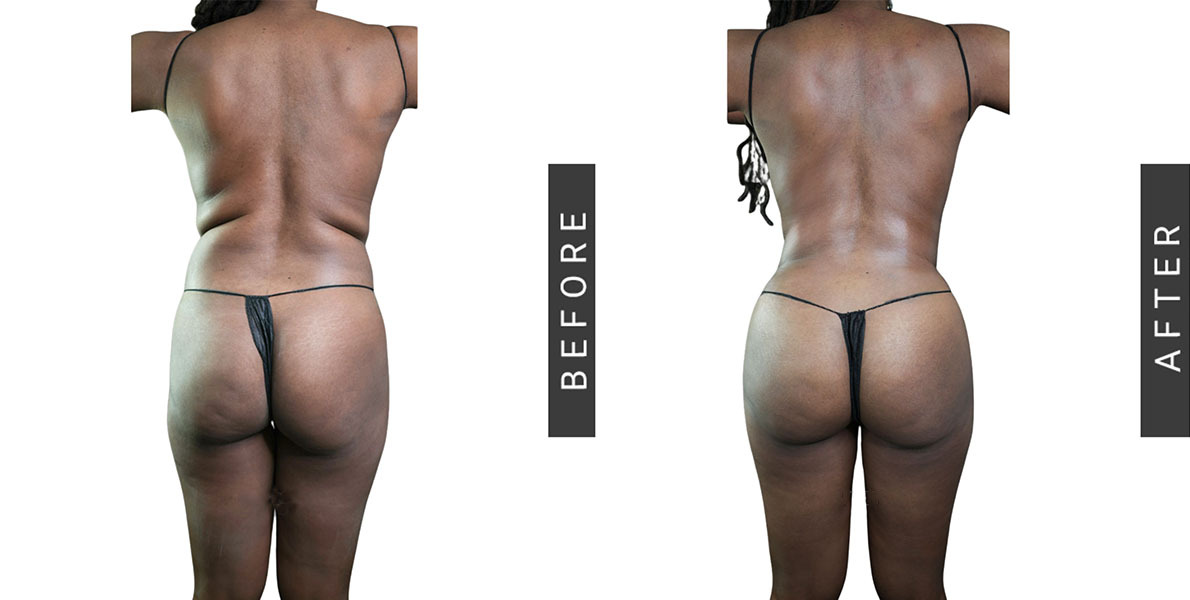 Lipo 360 and BBL Before and After