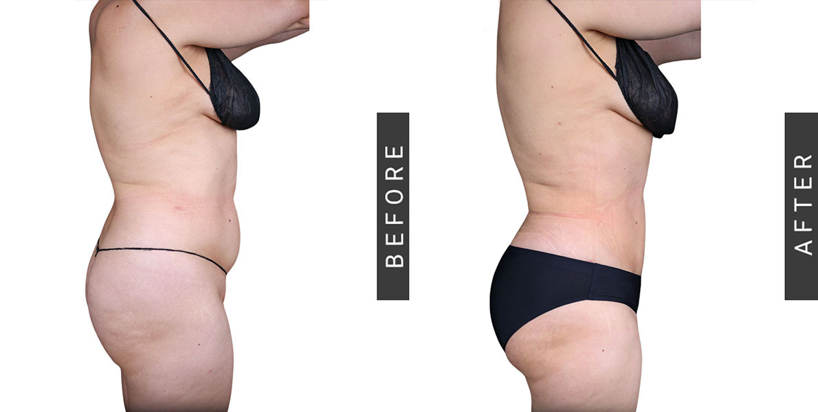 Lipo 360 and BBL Before and After