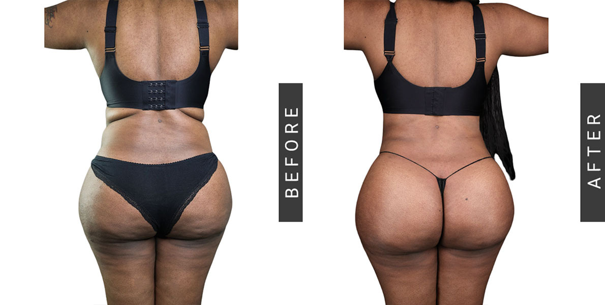 Lipo 360 and BBL Before and After