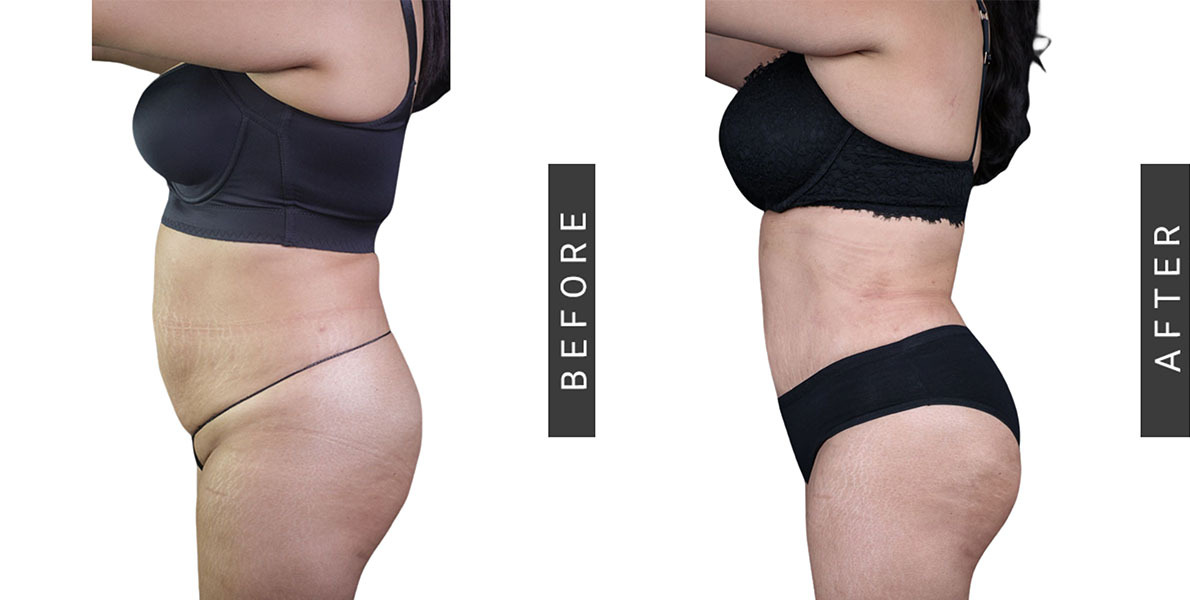 BBL with Tummy Tuck and Lipo360 Before and After
